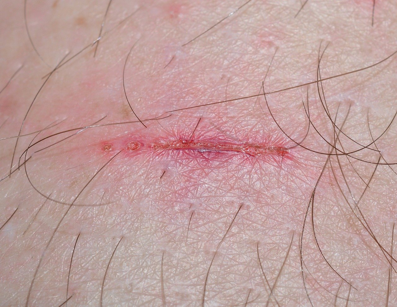 bị trầy xước
