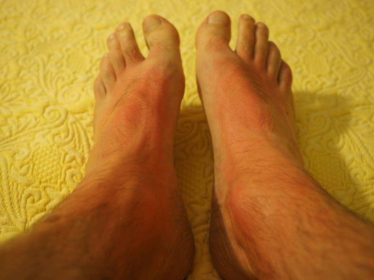 bị cháy nắng